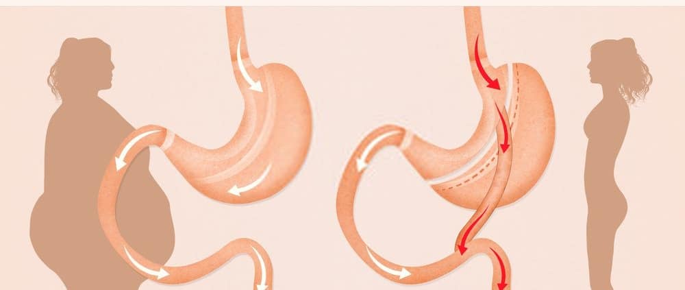 تجربتي مع عملية تحويل المسار