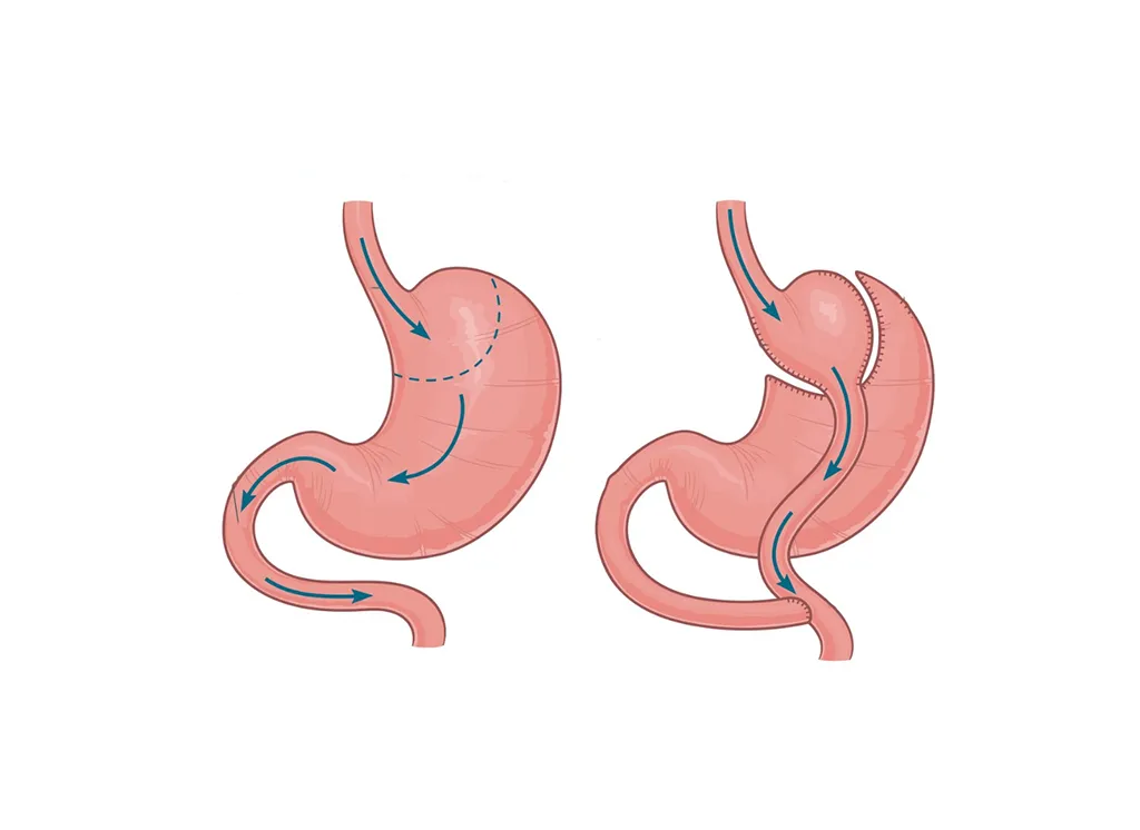 عملية تحويل المسار الكلاسيكي