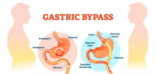 قبل عملية تحويل المسار